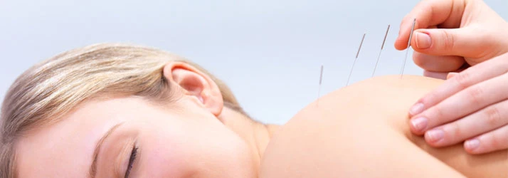 Close-up of a person lying face down while thin needles are inserted into the upper back by a hand in a clinical setting.