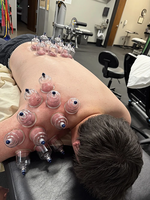 A patient receiving cupping therapy on his lower back and shoulders